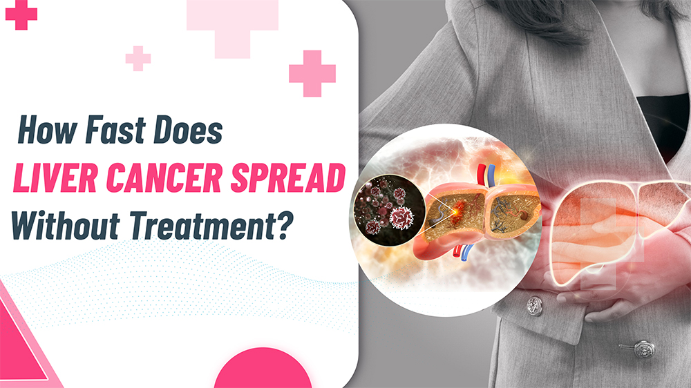 How Fast Does Liver Cancer Spread Without Treatment?