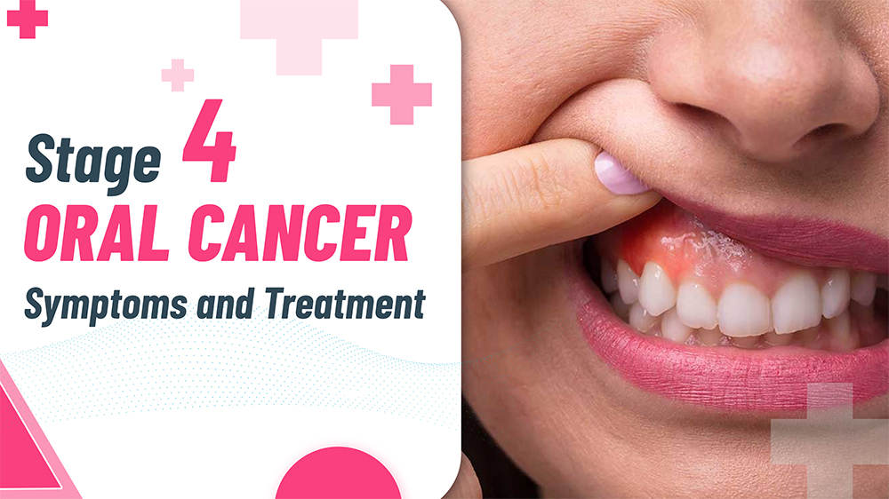 Stage 4 Oral Cancer: Symptoms and Treatment